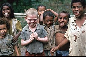 Kinder und ein Albino-Junge